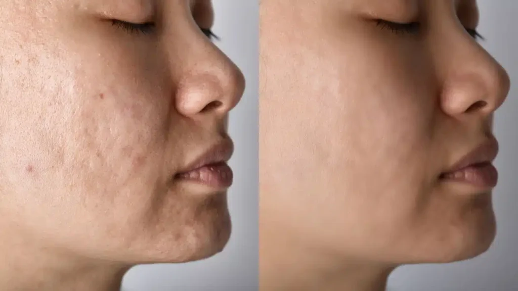 Điều trị mụn nội tiết: Hướng dẫn toàn diện cho làn da khỏe đẹp