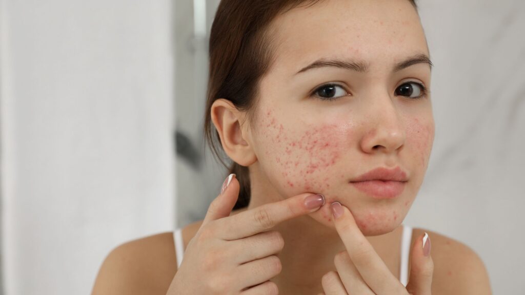 Điều trị mụn trứng cá: Hướng dẫn toàn diện từ A đến Z