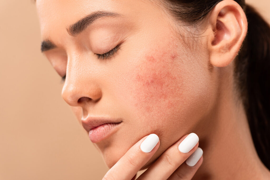 Điều trị mụn trứng cá: Hướng dẫn toàn diện từ A đến Z