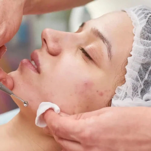 Điều trị mụn trứng cá: Hướng dẫn toàn diện từ A đến Z