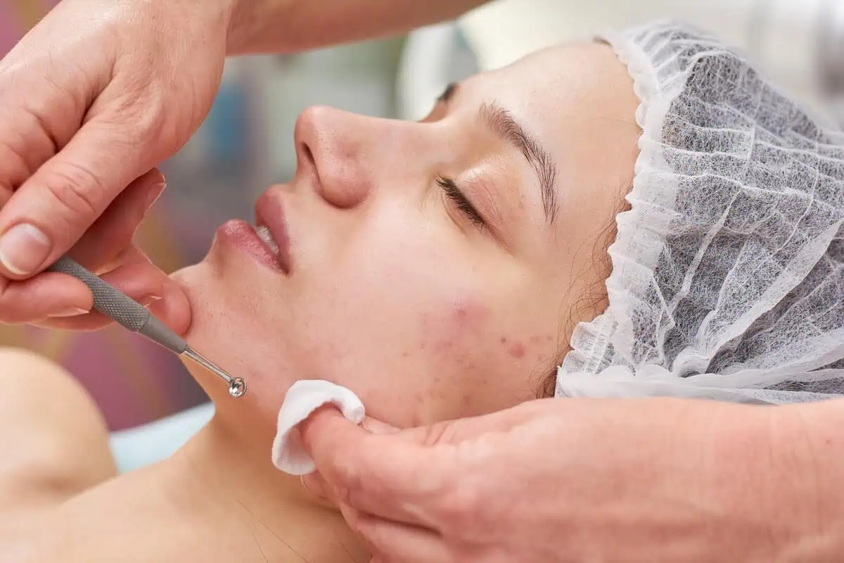Điều trị mụn trứng cá: Hướng dẫn toàn diện từ A đến Z